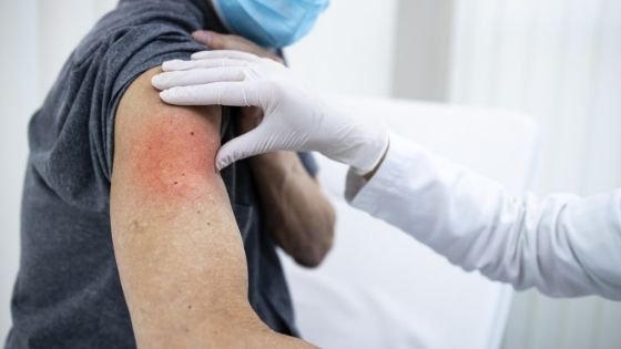 Close up of an arm experiencing redness post vaccination-7.jpeg