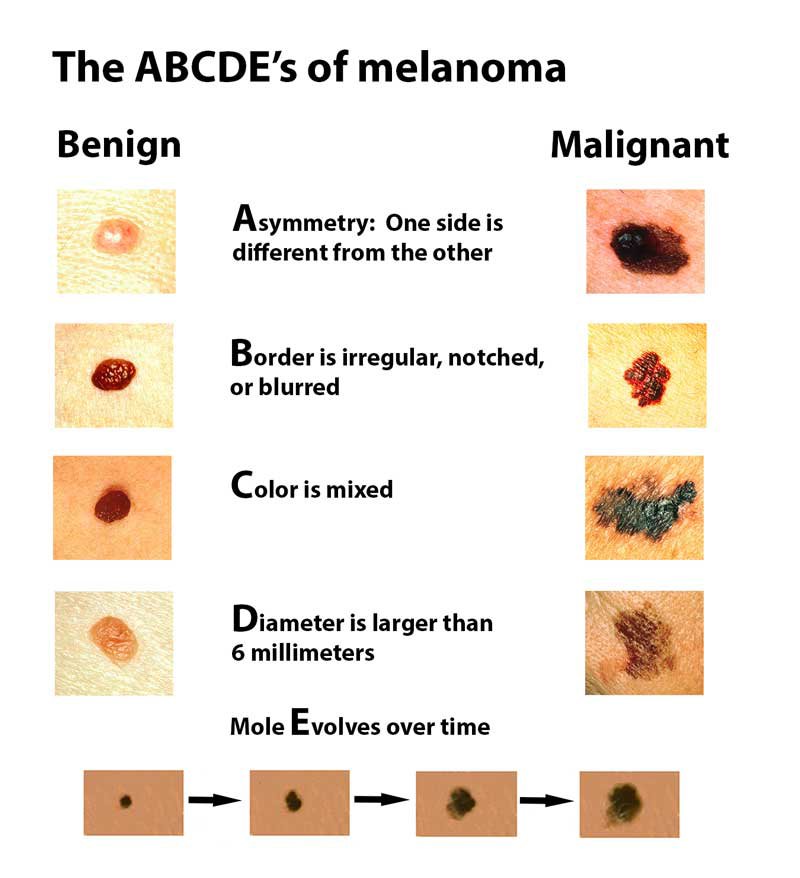 skin moles to worry about