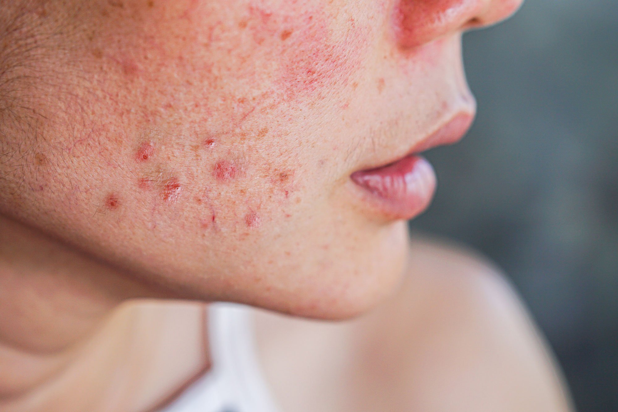 Woman's face with acne