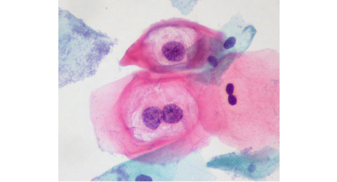 human papillomavirus pap