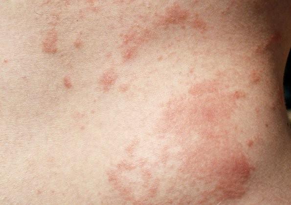 poison ivy rash