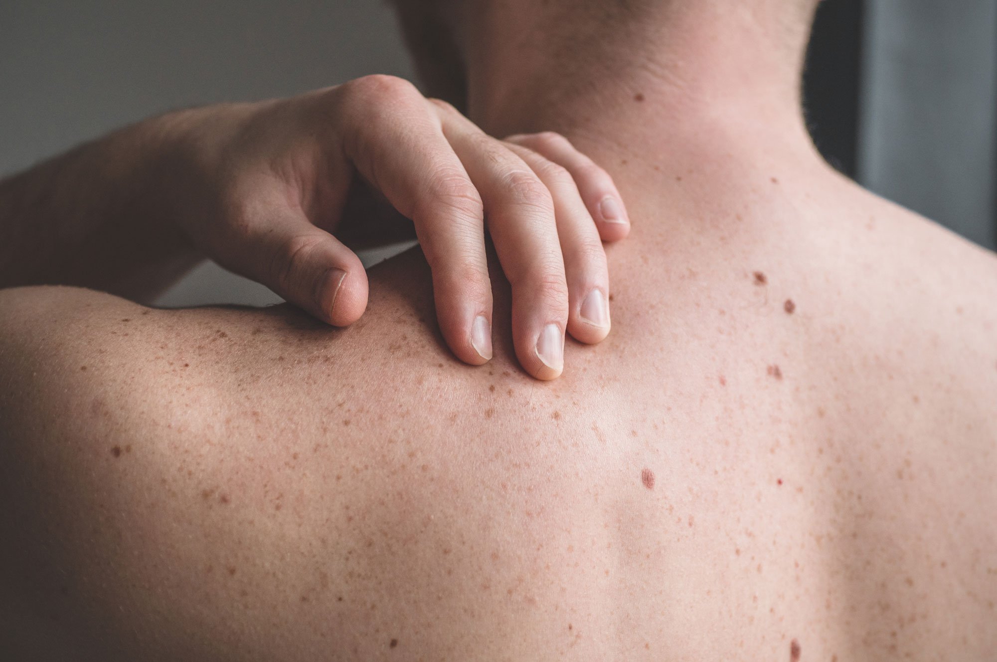 what-to-know-about-skin-cancer-skin-checks.jpg